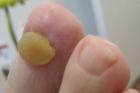 Was tun gegen Fußnagelpilz 1x kostenfreie med. Fußpflege von Jenn Cosmetic.